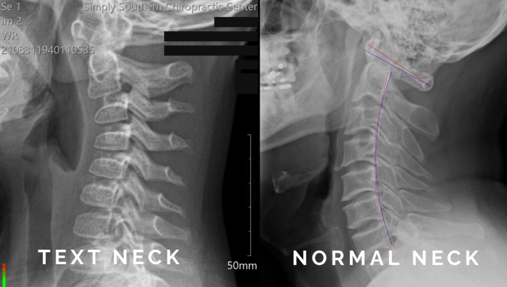 Chiropractic for Tech Neck and Text Thumb | Simply Southern Chiro
