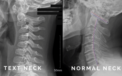 Tech Neck and Text Thumb: How Chiropractic Care Helps Patients of All Ages
